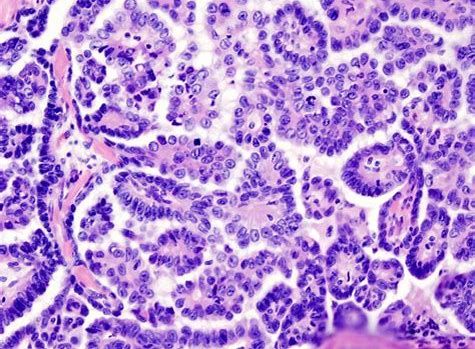 CancerRes：新研究发现帮助清除癌症干细胞的新靶标